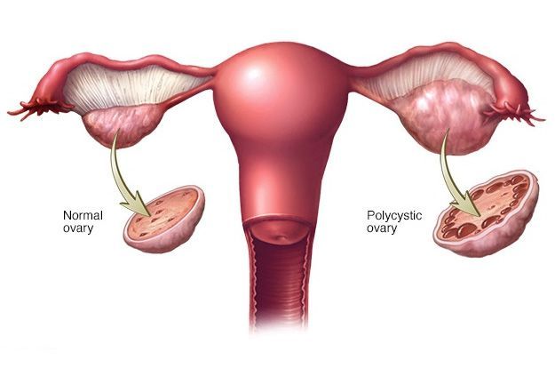 Best PCOD/PCOS Exercises at Home